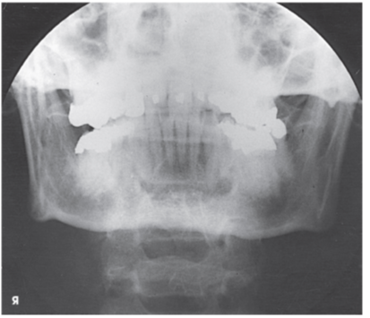 <p>What projection and anatomy is demonstrated in the image below?</p><p> </p><p>AP axial of the TMJs</p><p> </p><p>PA axial of the mandibular rami</p><p> </p><p>PA of the mandibular body</p><p> </p><p>Axiolateral oblique of the mandibular body</p>