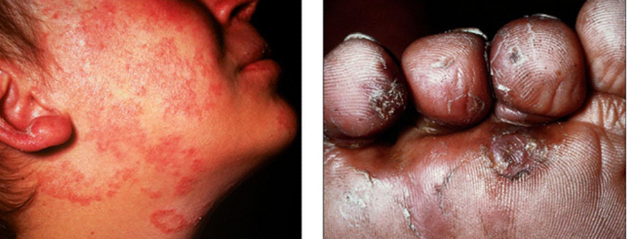 <p>Mycosis (3 types)</p>