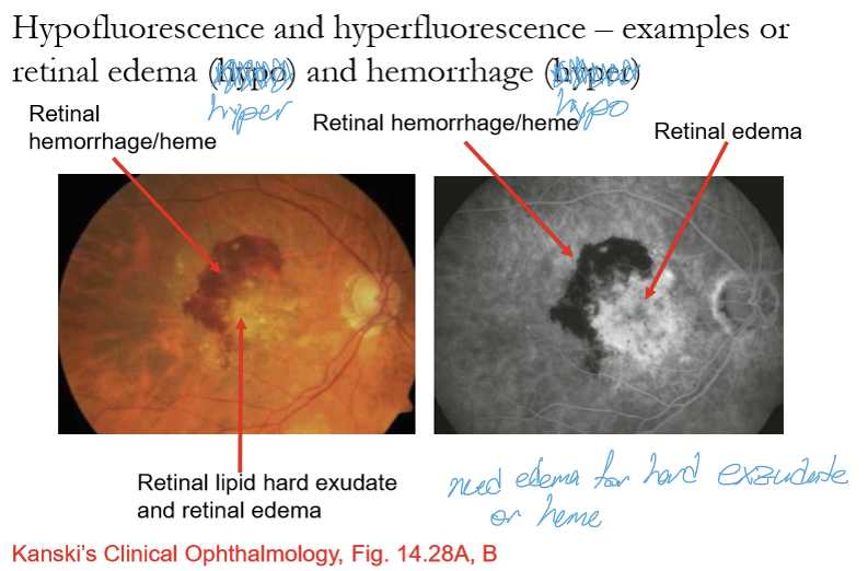 <ul><li><p>Vessel closure / non‑perfusion → no fluorescein entering the capillary bed.</p></li><li><p>Blockage from pigment or blood (melanin, hemorrhage, CHRPE).</p></li><li><p>Cotton wool spots: axoplasmic stasis blocks underlying choroidal fluorescence.</p></li></ul><p></p>