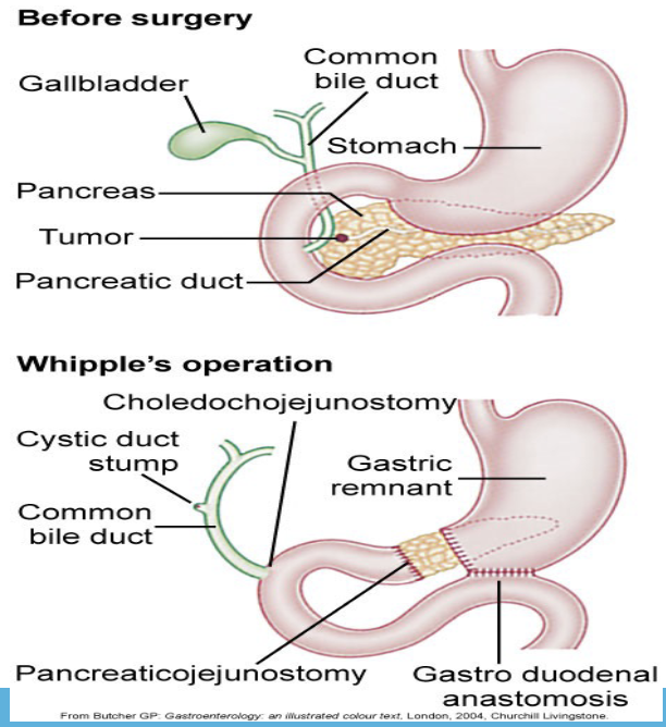 <p>Whipple’s operation / radical pancreaticoduodenectomy </p><p>-resection of proximal pancreas, duodenum, distal stomach and distal common bile duct </p><p>-anastomosis created between pancreatic duct, common bile duct, and stomach to jejunum</p>
