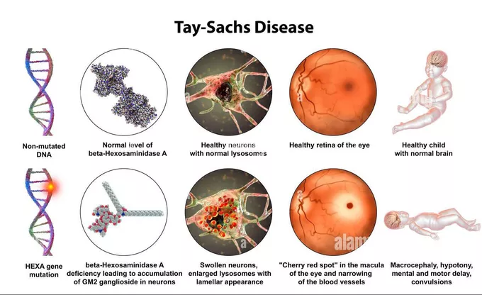 <p><strong>Tay Sachs Disease</strong>: What happens when GM2 builds up in neurons?</p>