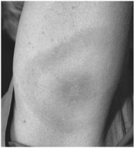 <p>The appearance of this rash is characteristic of infections with which of the following?</p><p>• dengue virus</p><p>• Epstein-Barr virus</p><p>• Francisella tularensis</p><p>• Yersinia pestis</p><p>• Borrelia burgdorferi</p><p></p>