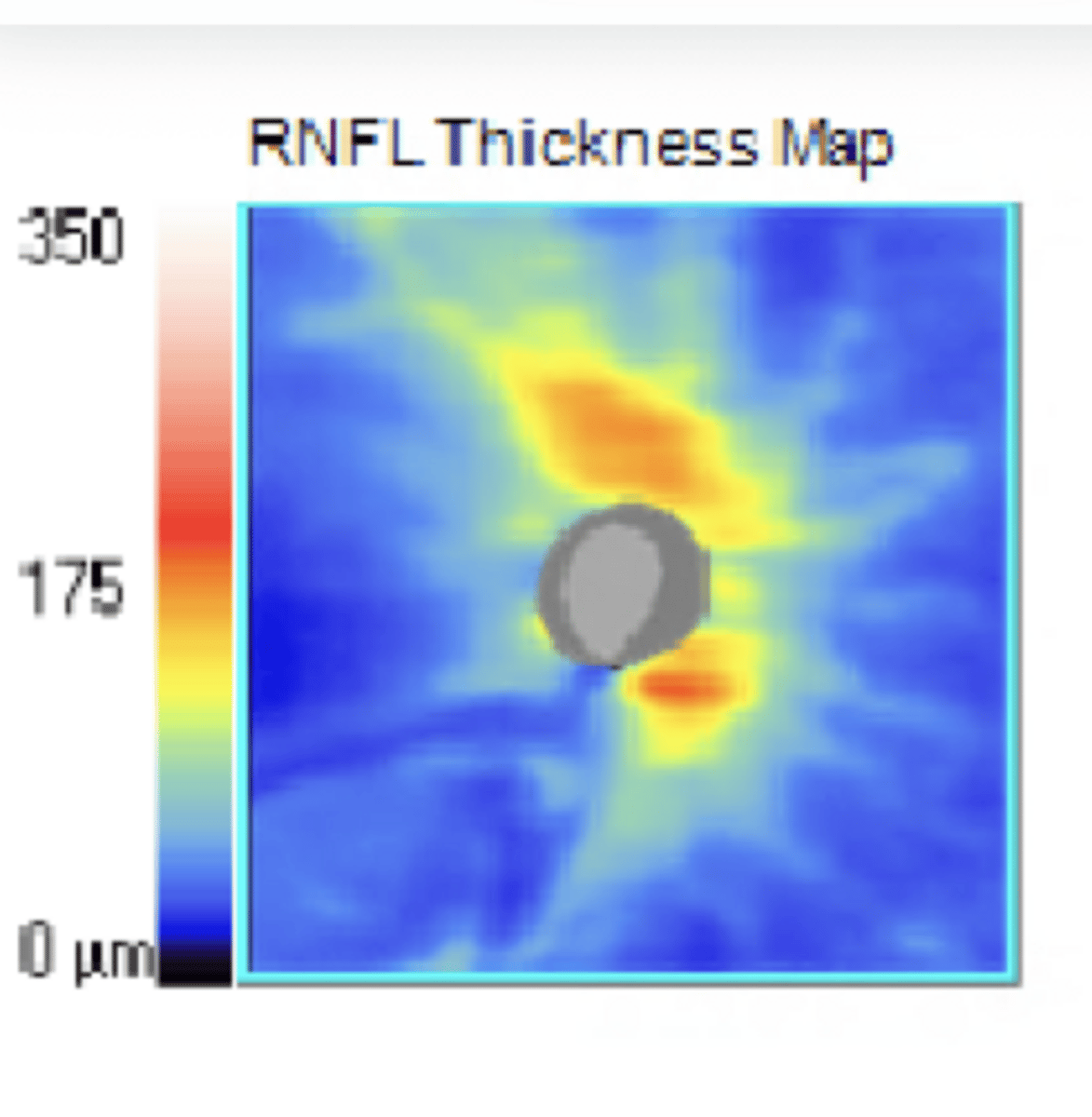 <p>RNFL Thickness Appearance for IT Drance Hemorrhage</p><p>**IT thinning shown</p>