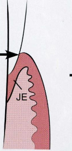 <p>stage of passsive eruption: the most apical limit of the attachment is on the cementum, with the base of the gingival sulcus still on the enamel surface</p>