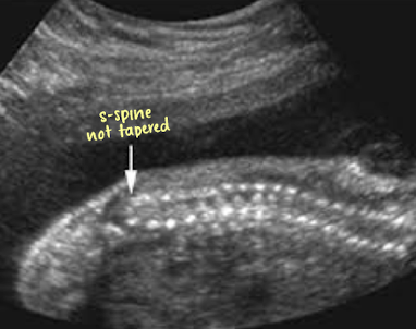 <ul><li><p>sacral agenesis</p></li><li><p>talipes</p></li><li><p>abnormal lumbar vertebrae</p></li><li><p>abrupt termination of the spine</p></li><li><p>lower extremity contractures </p></li></ul><p></p>