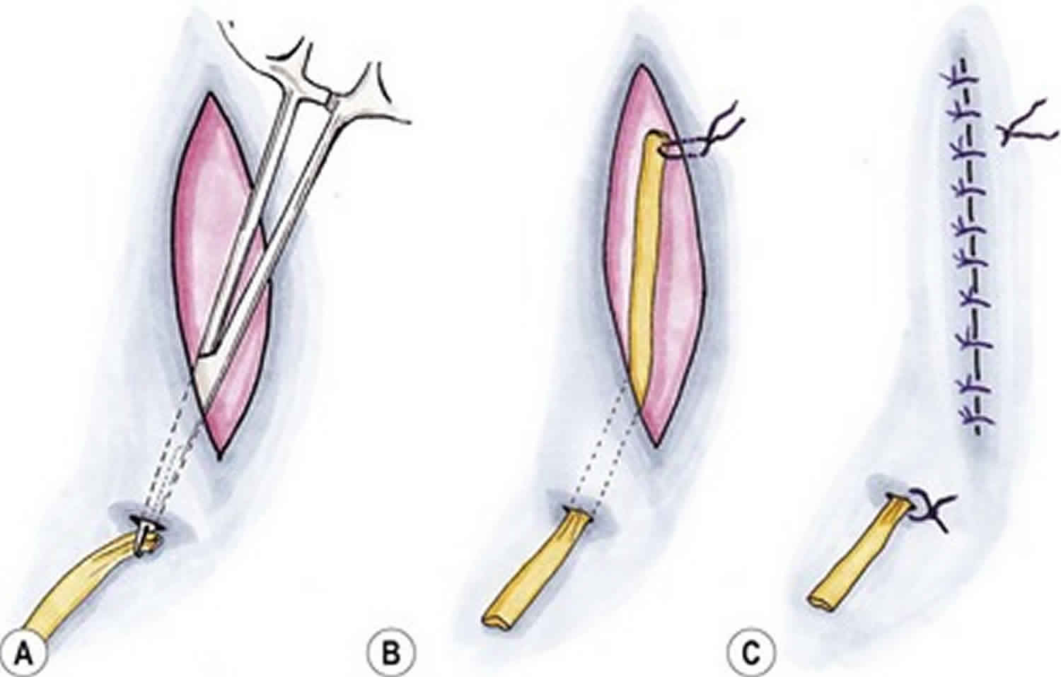 <p>open drainage system that allows for blood, pus, or other fluid to freely drain using gravity (passive drainage)</p>
