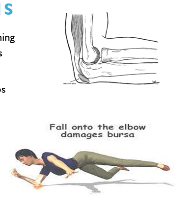 <ul><li><p>Bursae are closed fluid filled sacs with a synovial lining that facilitates gliding of musculoskeletal structures over one another during motion. </p></li><li><p>The floor of the olecranon bursa lies on the triceps tendon and olecranon, and the roof is loosely connected to the overlying skin of the elbow </p></li><li><p>MOI usually fall or repeated rub/blows to elbow </p></li><li><p>Single trauma </p></li><li><p>Repeated rub from boards </p></li><li><p>Student’s elbow</p></li></ul><p></p>