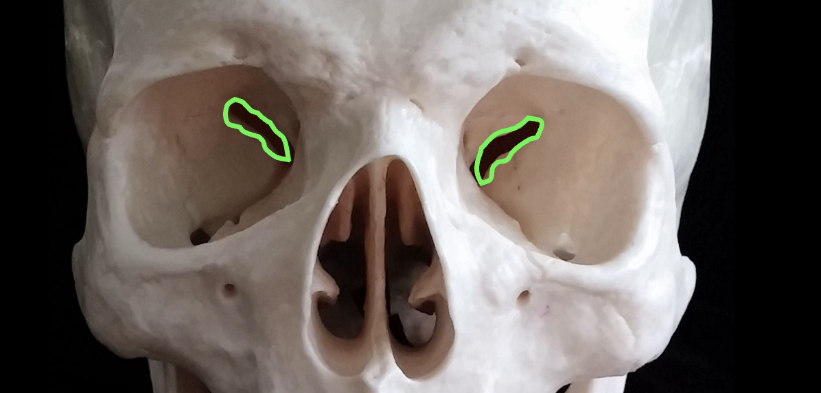 <p>What is the green region highlighted on the sphenoid bone?</p>