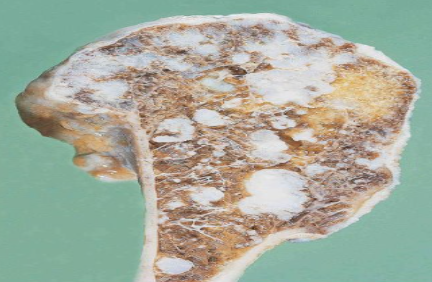 <p>What disease is this?</p>