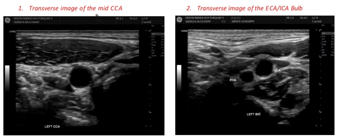 <p>Begin at the patients clavicle adjust depth gain and focus (you want the vessel to be anechoic) </p><p>Work your way up surveying the common carotid artery until the bifcuation and back down. </p><p>Take your first transverse image of the common carotid artery then bring the transducer up and scan the patients ICA and ECA.</p><p>ICA (lateral) ECA (medial)</p>