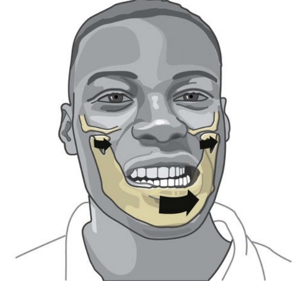 <p>• Called lateral deviation or lateral excursion—is the side-to-side movement of the mandible, used primarily in chewing and grinding motions. </p><p>• Lateral excursion is a combined motion that occurs in both TMJs simultaneously, but in different ways on each side </p><p><strong>Ipsilateral TMJ </strong>(same side as movement) Rotates or pivots around a vertical axis in the lower joint compartment with minimal translation </p><p><strong>Contralateral TMJ </strong>(opposite side) Translates anteriorly and medially in the upper joint The condyle and disc glide forward and inward</p><p>Normal Range of Lateral Excursion:~8–12 mm per side</p>