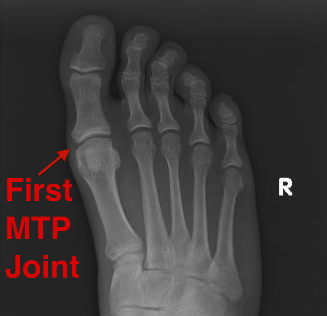 <p>What is the classic location for gout?</p>