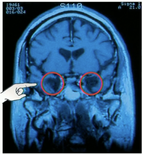 <p><strong>overview:</strong></p><ul><li><p>H.M experienced seizures in childhood that became severe as a teenager</p></li><li><p>underwent experimental surgery in his 20s that resected his <strong>bilateral medial temporal lobes</strong> because thats where a surgeon thought HM’s epilepsy was originating from</p></li></ul><p><strong>result</strong>:</p><ul><li><p>surgery was successful in reducing the severity of his epilepsy but his memory was profoundly impaired</p></li></ul><p></p><p><strong>HM’s pattern of memory loss:</strong></p><ul><li><p><strong>had anterograde amnesia + retrograde amnesia (specifically temporally graded retrograded amnesia)</strong></p></li><li><p>his early memories seem to be intact (same as healthy individuals)</p></li><li><p>HM’s deficits were remarkably specific to <strong>episodic memory</strong> → could not form new episodic memories in any modality (spatial, visual, verbal, etc.)</p></li><li><p>however <strong>all other cognitive abilities were intact</strong> ( normal working memory, semantic memory, procedural memory ( speech understanding.. etc.)</p></li><li><p>due to impairment in hippocampus → could recall semantic aspects of memories but not episodic memories</p></li></ul><p></p><p></p>