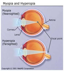 <p>farsighted; defect in near vision</p>