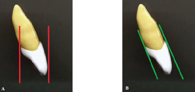 <p><span style="color: rgb(255, 0, 0);"><strong>A: Incorrect </strong></span></p><ul><li><p>Red lines — incorrect alignment to lingual and facial surfaces of maxillary central incisor</p></li></ul><p></p><p><span style="color: green;"><strong>B: Correct</strong></span></p><ul><li><p>Green lines — Correct alignment to lingual and facial surfaces of maxillary central incisor</p></li></ul><p></p>