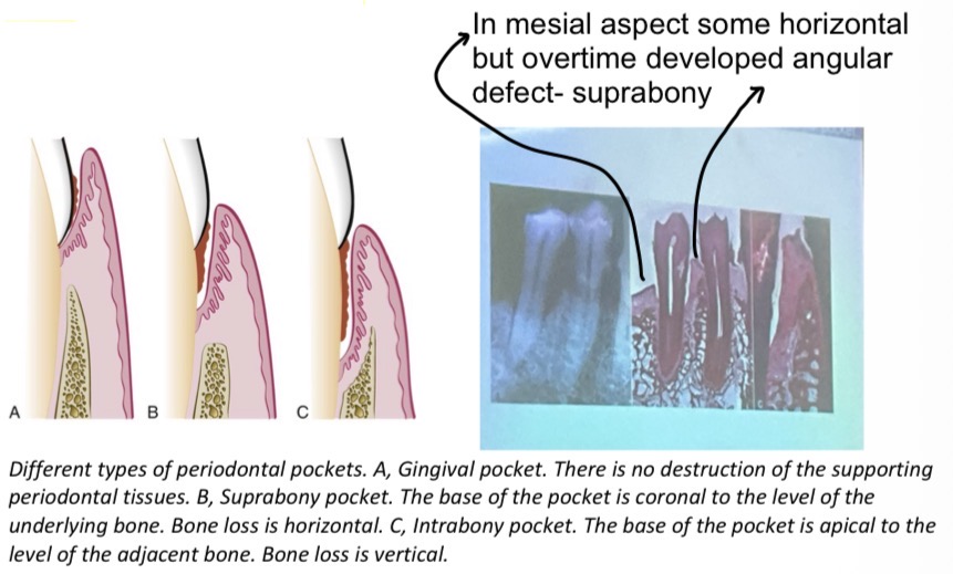<p>Bottom of pocket is <strong>coronal</strong> to underlying alveolar bone</p><p>Type 1- Bottom of bone apical to level of adjacent alveolar bone, type 2- lateral pocket wall lies bateen tooth surface and alveolar bone</p>