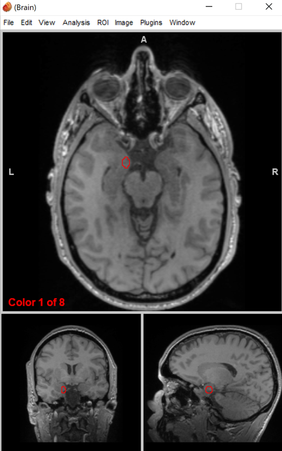 <p>amygdala</p>