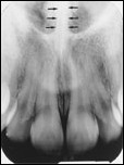 <p>nasal septum</p>