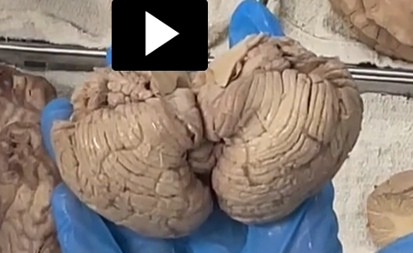 <p>inferior surface of the cerebellum </p>