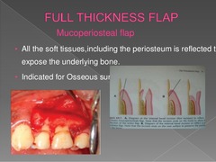 <p>1 month.</p><p>(Explanation: Full-thickness flaps, involving primary closure, heal faster than gingivectomies due to direct flap apposition, with epithelialization completing in about 4 weeks.)</p>
