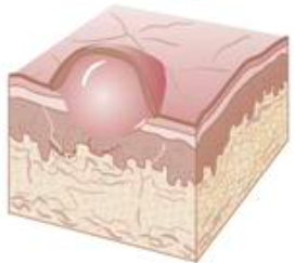 <p>small blister consist of<span style="color: red;"> fluid, serum, plasma, blood</span></p><p>flat, globoid or umbilicate, tense or flaccid in character</p>