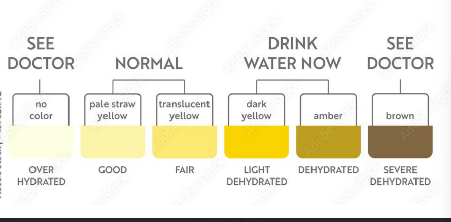 <ul><li><p>colored somewhat yellow due to the pigment of urochrome (from the destruction of hemoglobin—RBCs) and solutes</p><ul><li><p>When RBCs die, they release a substance called bilirubin, which is then converted into uroschrome by gut bacteria to give its yellow color</p></li></ul></li><li><p>sterile (no bacteria)</p></li><li><p>slightly aromatic</p><ul><li><p>if you have diabetes, urine will smell fruity</p></li></ul></li><li><p>Normal pH of around 6 (varies 4.5-8)</p></li><li><p>Specific density of 1.001 to 1.035 since 95% of urine is water</p></li><li><p>The typical urine volume for an adult is between 750-2000 mL a day</p></li><li><p>Solutes normally found in urine</p><ul><li><p>sodium and potassium ions</p></li><li><p>chloride ions</p></li><li><p>small amounts of other ions, hormones, metabolites, and pigments</p></li><li><p>urea (waste product from liver breaking down proteins)</p></li><li><p> uric acid</p></li><li><p> creatinine</p></li></ul></li><li><p>Solutes NOT normally found in urine</p><ul><li><p>glucose (diabetes)</p></li><li><p>Blood proteins (pregnancy, HBP)</p></li><li><p>Red blood cells (bleeding—trauma, kidney stones)</p></li><li><p>Hemoglobin (anemia)</p></li><li><p>White blood cells (pus) (UTI)</p></li><li><p>Bile (liver disease, hepatitis)<br></p></li></ul></li></ul><p></p>