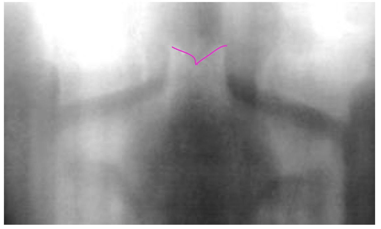 <p>What is the dx if this pt is <12 yo </p>