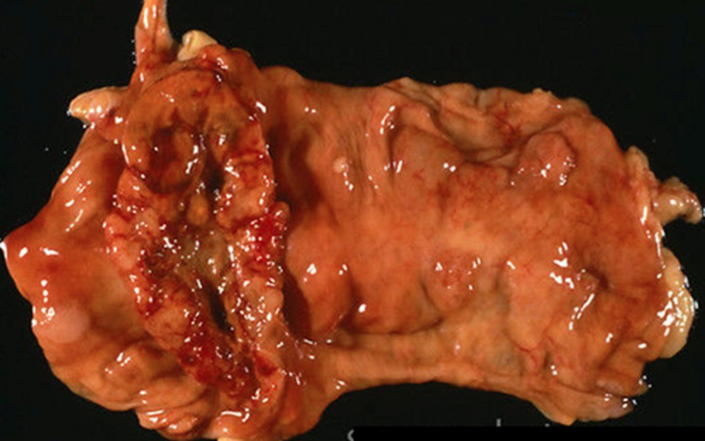 <p>colonic polyposis</p>