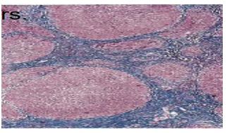<ol><li><p>Hepatocytes: Fatty change that decreases progressively; few show increased intracytoplasmic haemochromatosis. </p></li><li><p>Fibrous septa: Regular margins with regenerating nodules, moderate lymphocytic infiltrate, slight bile ductular proliferation.</p></li></ol><p></p>