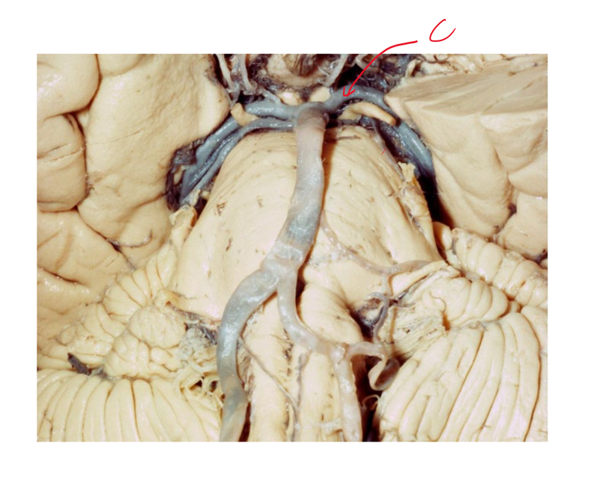 <p>What kind of nuclei damage, and hence brainstem symptoms can we expect to see from damaging artery C? what is the name of this syndrome?</p>
