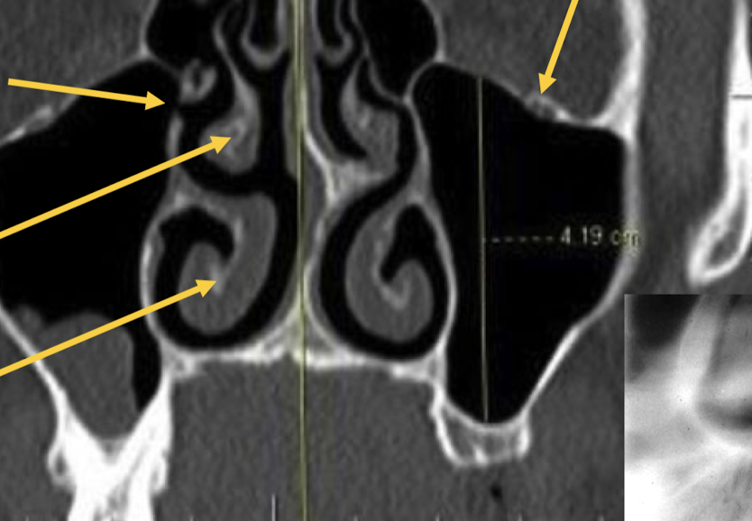 <p>Label and know the clinical implications for the passing of a nerve (which one?) through the roof of the maxillary sinus.</p>
