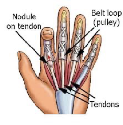 <p><span>•2 tendons to each finger</span></p><p><span>•Tendons run in sheath</span></p><p><span>•Thickenings in sheath = pulley</span></p><p><span>•Keep tendon close to bone</span></p><p><span>•Swelling in tendon catches on pulley </span></p>