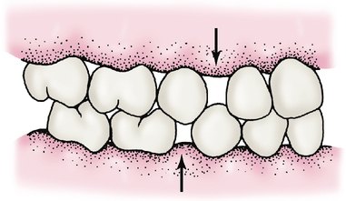 <ul><li><p><strong>max</strong>: <u>mesial</u> to the mand canine (Between lateral incisor & canine)</p></li><li><p><strong>mand:</strong> <u>distal</u> to the mand canine (Between canine & first molar)</p></li></ul><p></p>