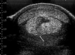 <p>Which flexor tendon injury is shown in the image?</p>