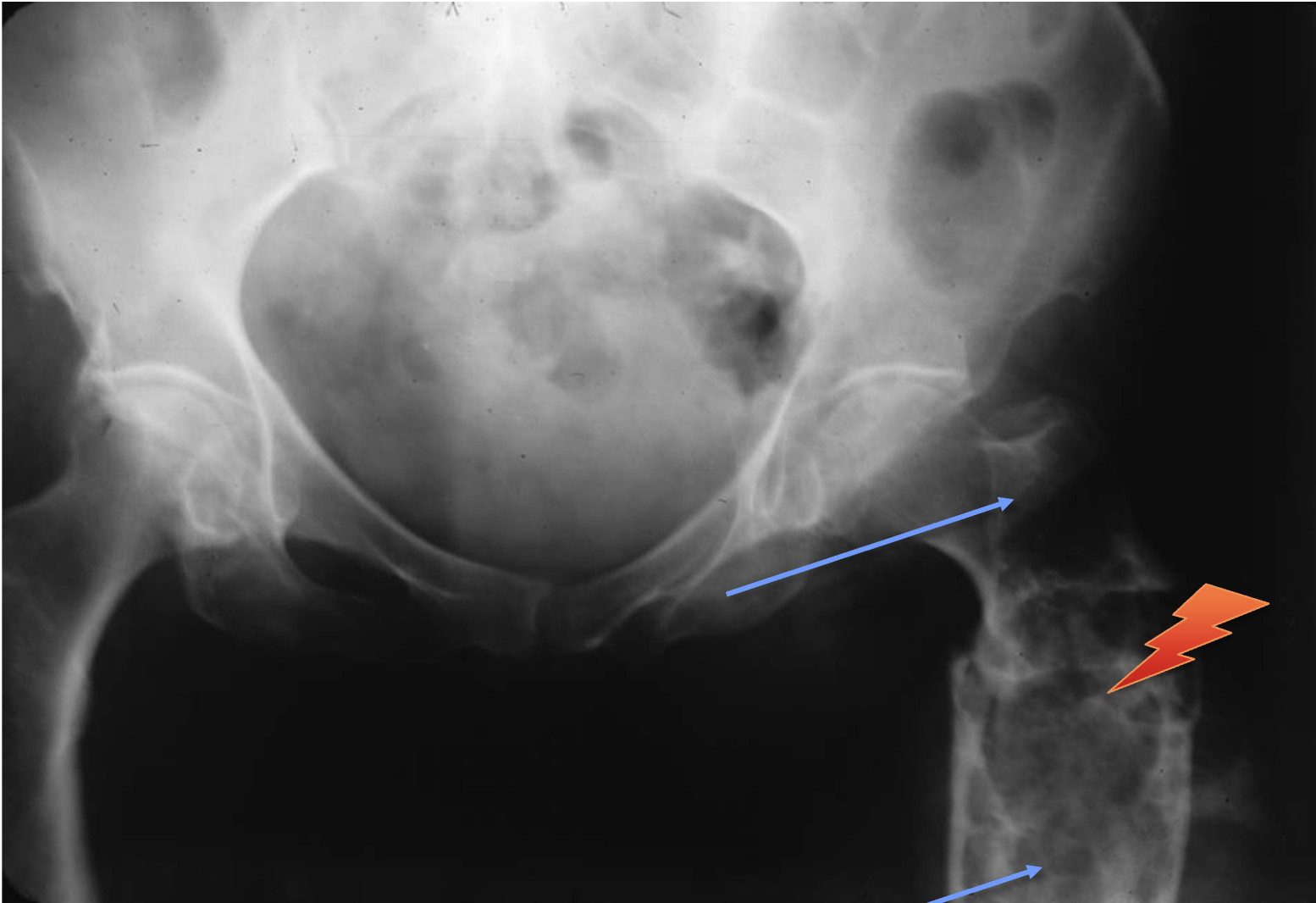<p>What tumour like disorder is this?</p>