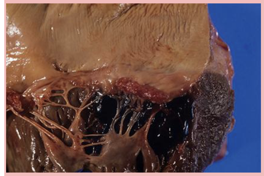 <p>Infection of endocardium and heart valves</p><ul><li><p>formerly called bacterial endocarditis</p></li><li><p>(commonly caused by streptococcus and staphylococcus)</p></li></ul><p></p>