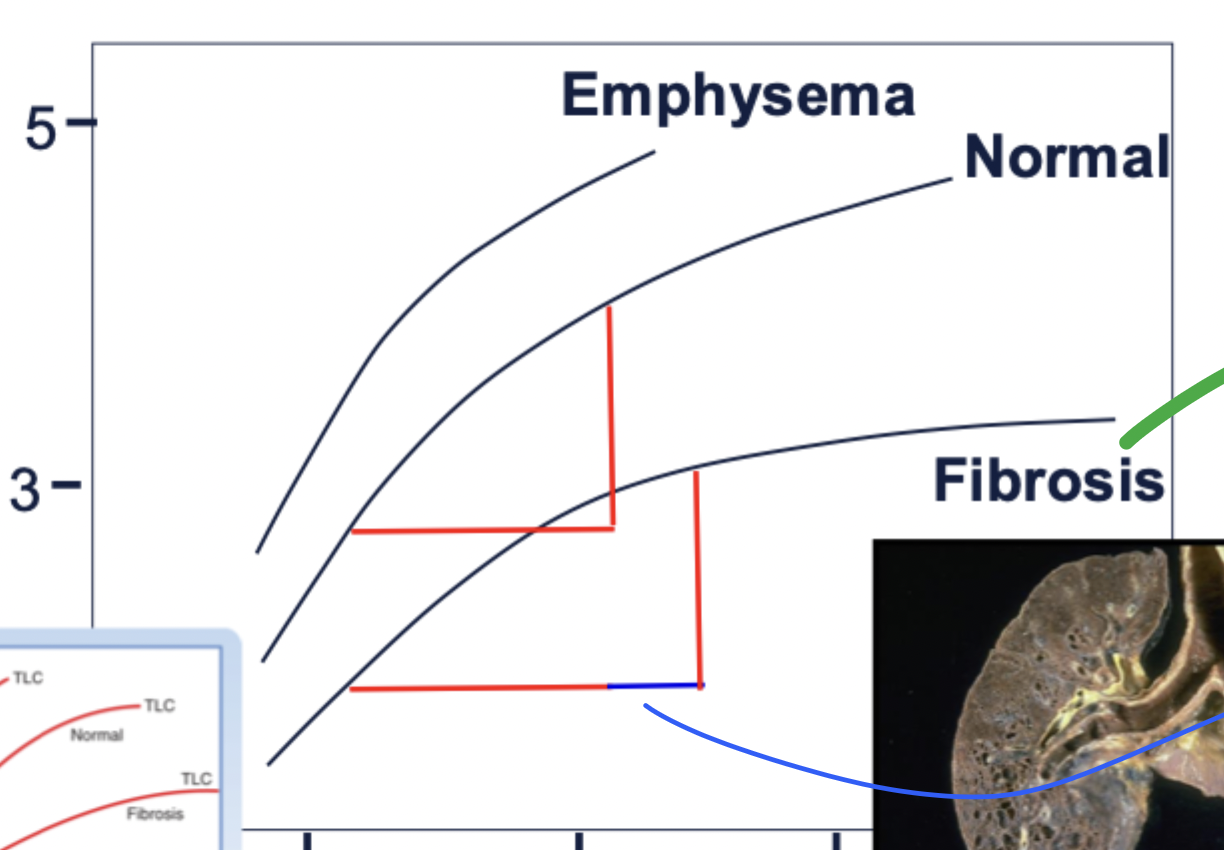 <p>what happens to someones compliance curve in a Tp vs volume graph when someone has emphysema</p>