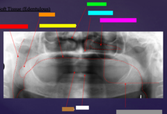 <p>ID the soft tissue anatomy indicated by the arrow pointing from the orange box:</p>
