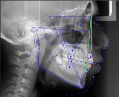 <p>What skeletal measurement:</p><p>- Nasion-A Point vs Nasion-B Point</p><p>- ANB=SNA-SNB</p><p>- This means ANB can be negative!!!!!</p><p>- AP relationship between the maxilla and the mandible</p><p>- Tells you about the AP skeletal classification</p>