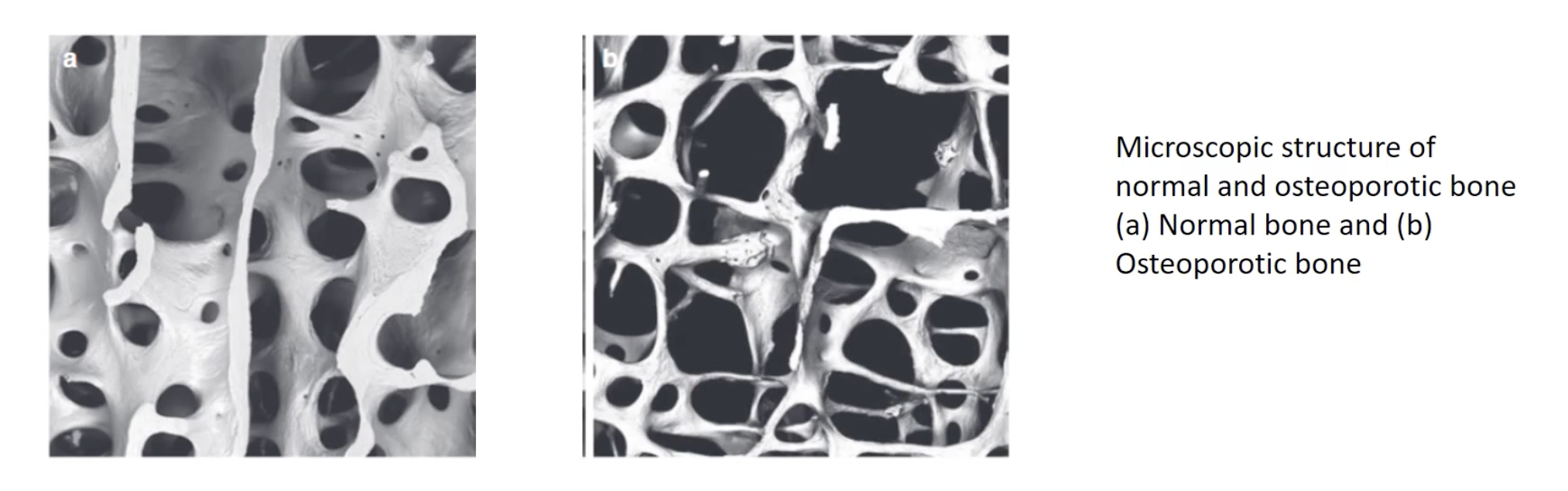 <ul><li><p>Bone density is 2.5 standard deviations below the mean</p></li><li><p>Bones become thin, weak + fragile</p></li></ul><p></p>