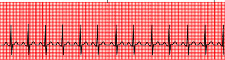 <p>how did you know this was sinus tachycardia</p>