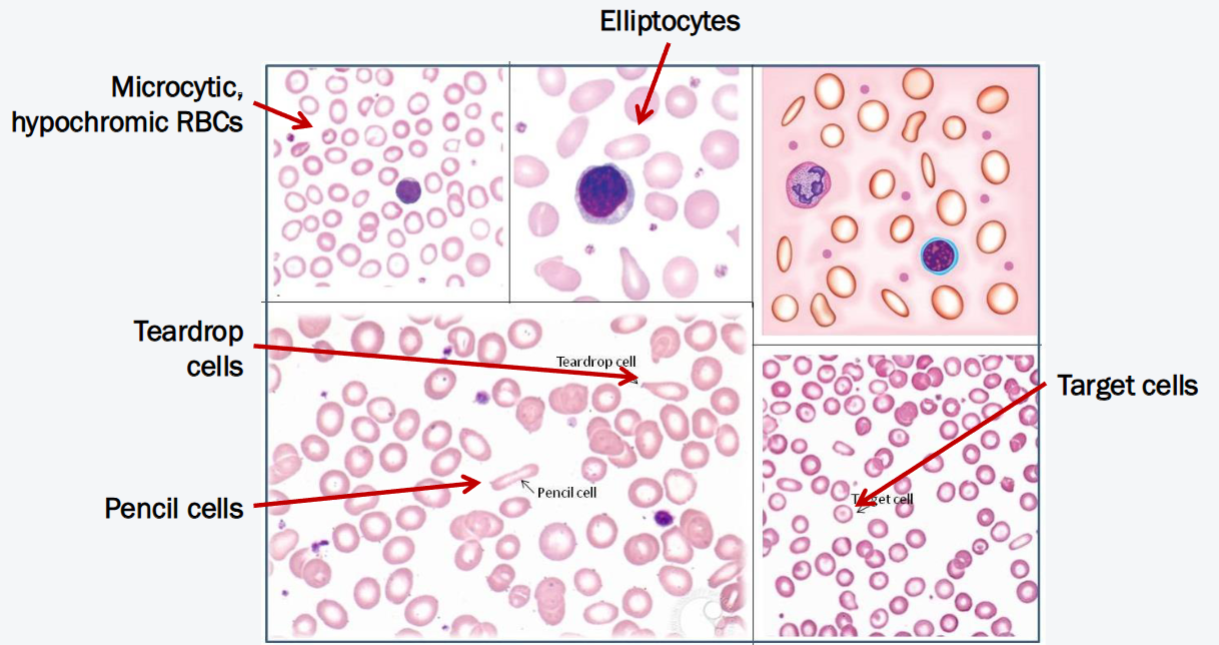 <p>What anemia do these peripheral blood smears indicate?</p>