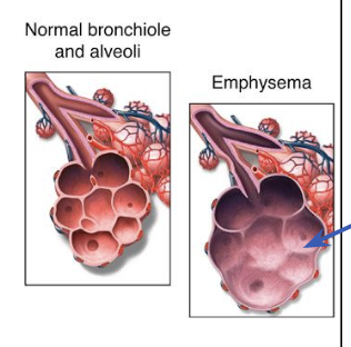 <p><span style="background-color: transparent;">Emphysema</span></p><p></p>