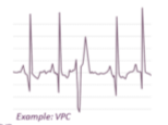 <p>What arrhythmia is this</p>