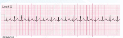 <p><strong><u>SINUS TACHYCARDIA</u></strong></p><ol><li><p>HR ____ bpm</p></li><li><p>s/s → 5</p></li></ol><p></p>