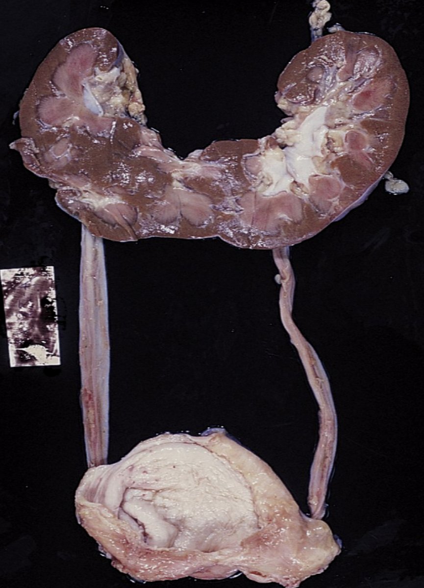 <p>Horseshoe kidney</p>
