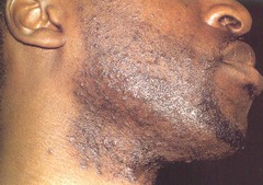 <p>Small erythematous papules/pustules centered on follicles.</p>