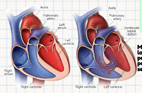 <p>A pathological problem where there is a <strong>hole in the wall between the left and right ventricles</strong> that enables abnormal passage of blood between these two chambers.</p>