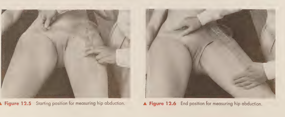 <p>is achieved by placing the axis of the goniometer over the anterior superior iliac spine, aligning the stationary arm with the opposite ASIS, and the moving arm along the midline of the femur. </p>