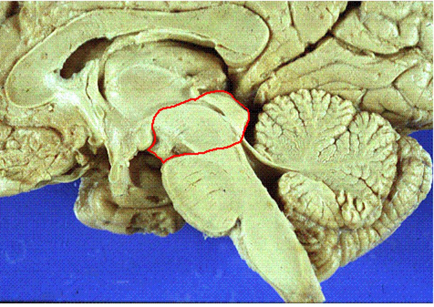 <p>- Midbrain; contains Tectum (superior/inferior colliculi) and Tegmentum (periaqueductal gray, substantia nigra, red nucleus).</p>